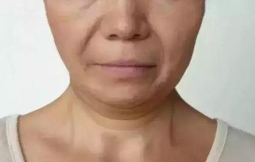 明星网红的下颌线,打造完美轮廓的秘密武器